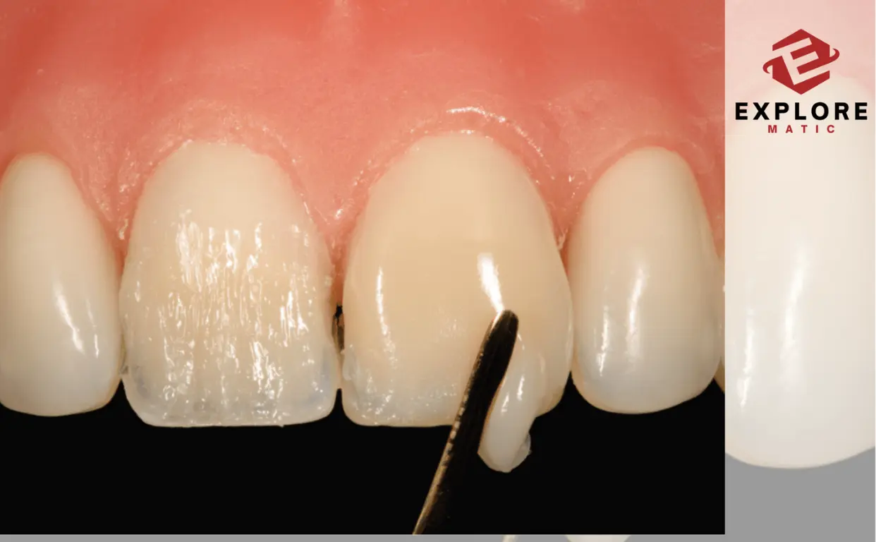 Veneers-Price-Estimate-Transform-Your-Teeth-With-Style-explorematic.com